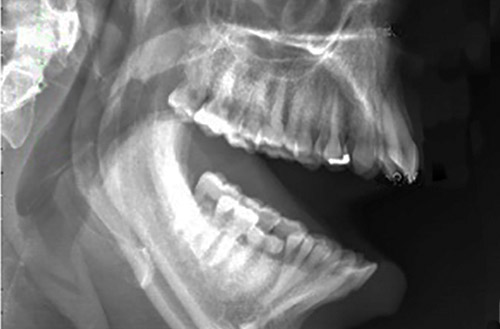 Management Of Recurrent Dislocation Of The Tmj Penn Medicine